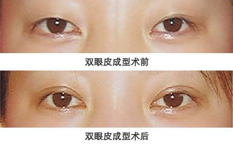 郑州双眼皮修复权威专家排行榜 郑州双眼皮修复最好的专家排名 郑州双眼皮修复最好的专家有哪些?