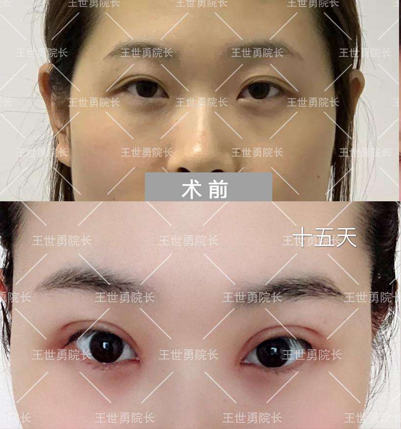 中国哪一位医生修复双眼皮最好？