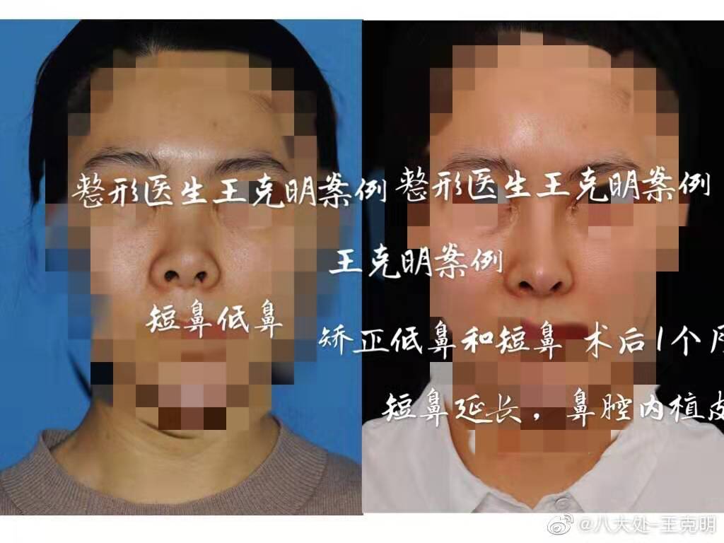 王克明隆鼻案例