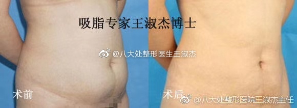 王淑杰腰腹吸脂案例