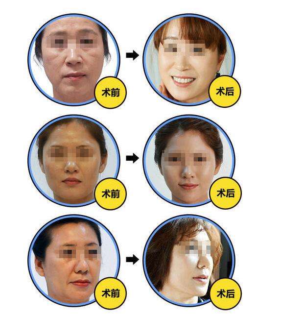 九院做面部提升最好的医生：金云波和李青峰