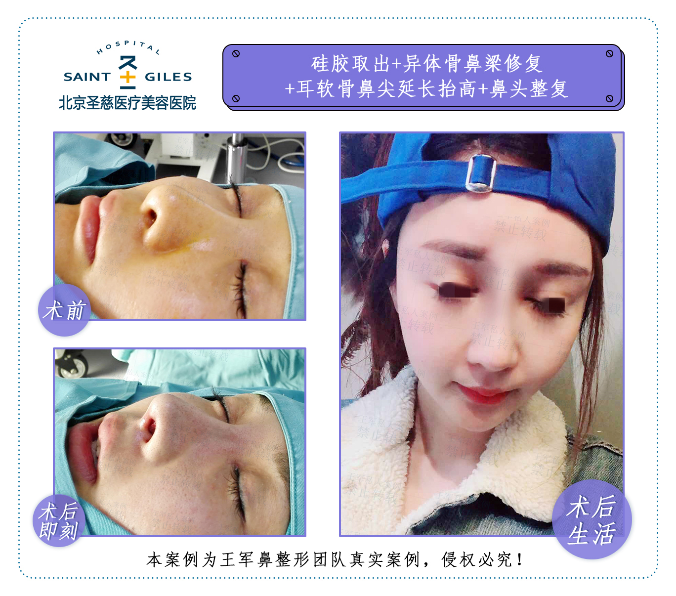 王军鼻修复案例