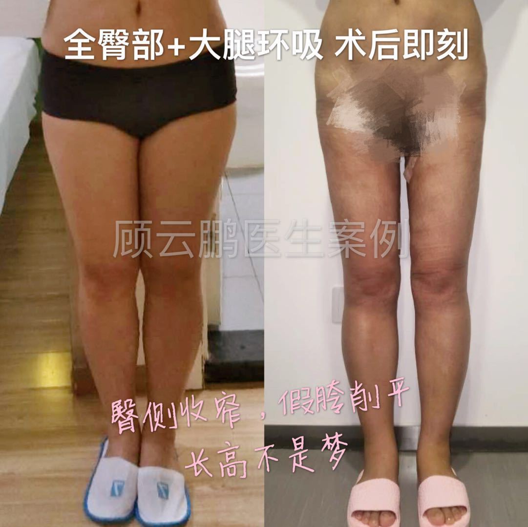 大腿吸脂案例