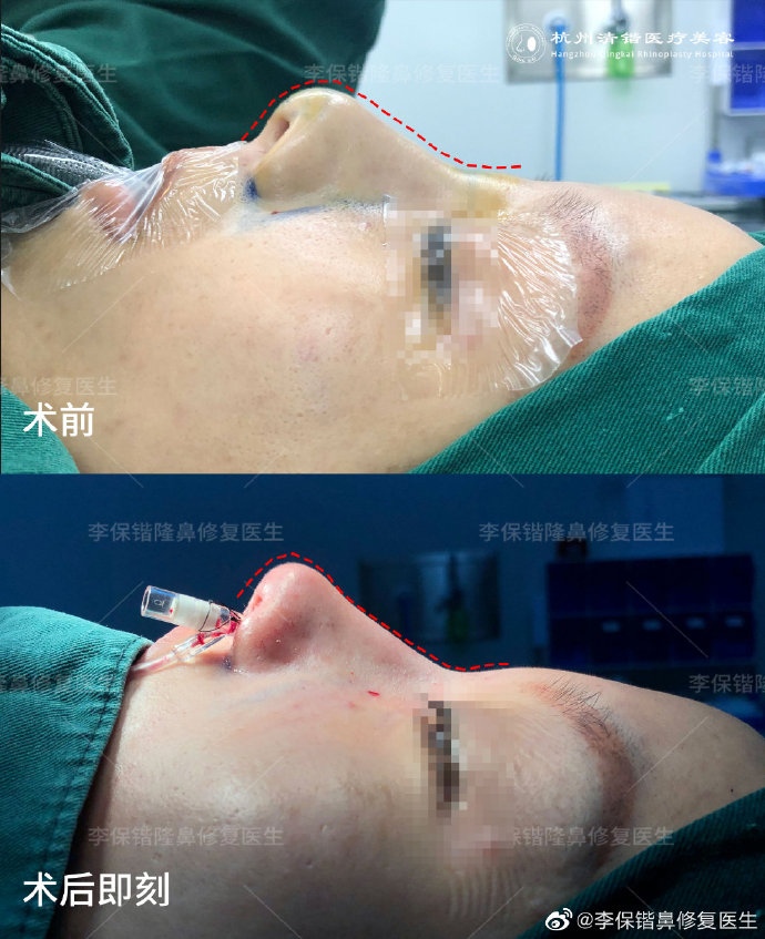 李保锴鼻修复案例
