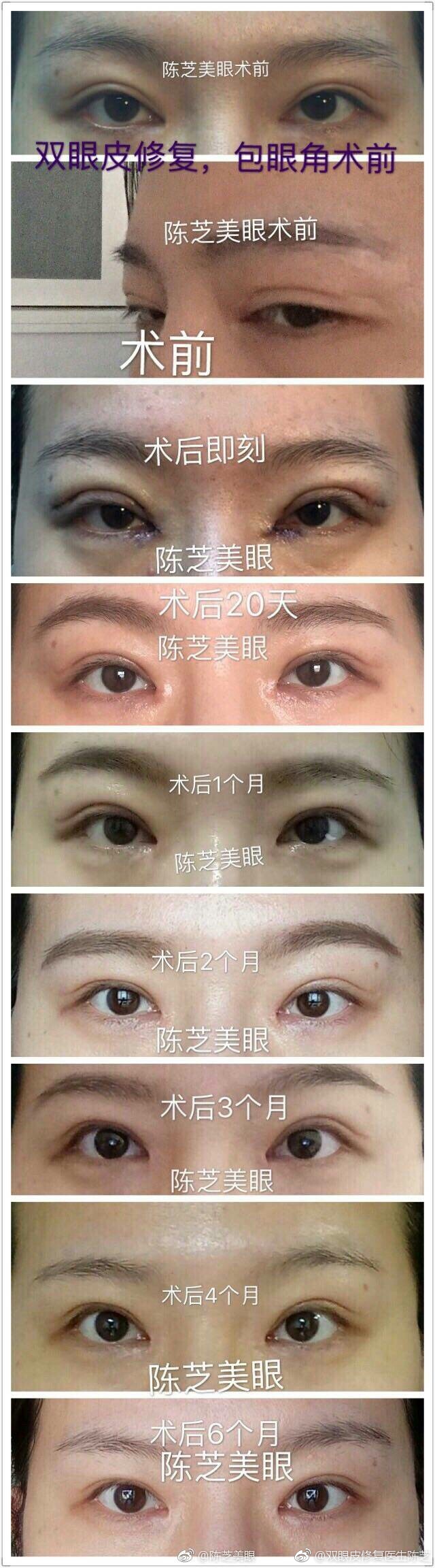 陈芝修复双眼皮案例
