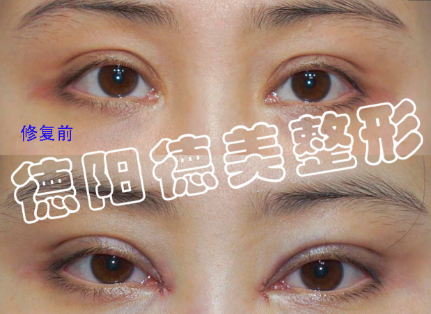 俞惠忠修复双眼皮案例