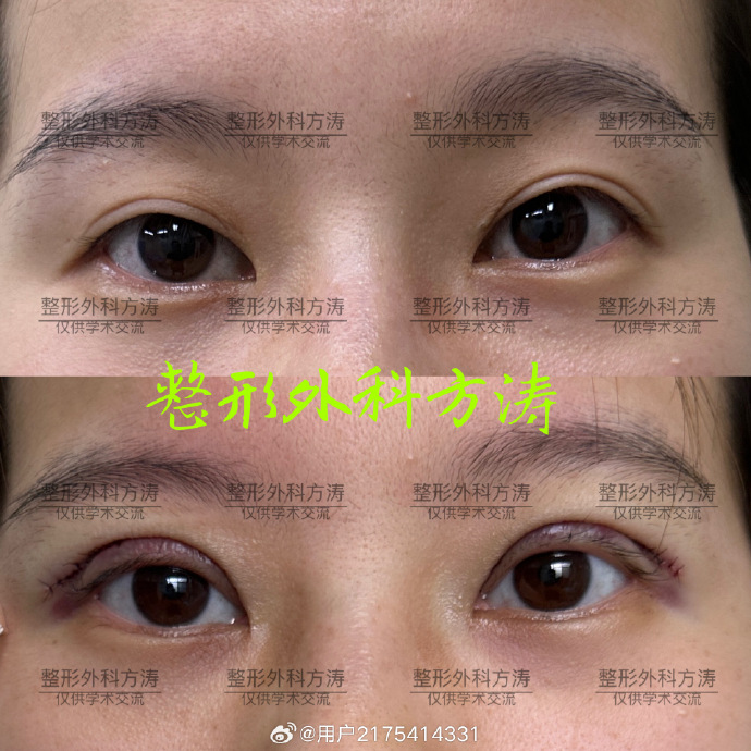 双眼皮修复方涛和刘晓伟哪个医生技术好？