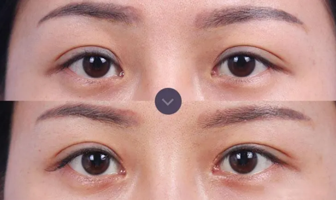 北京双眼皮修复最厉害医生是哪个？