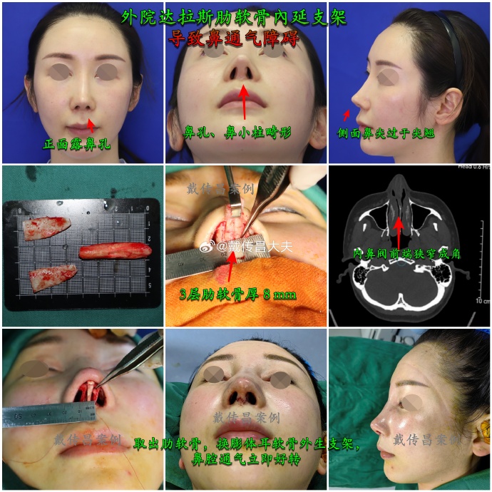戴传昌鼻修复案例