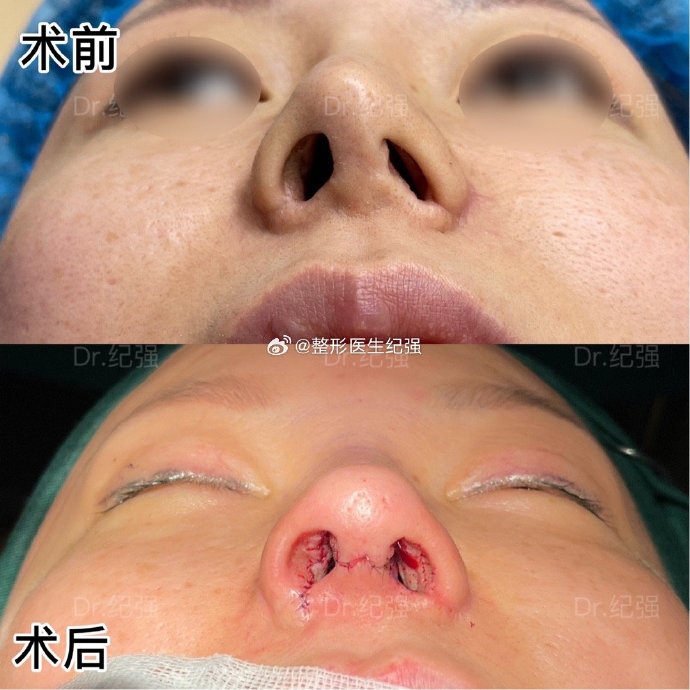 纪强隆鼻案例