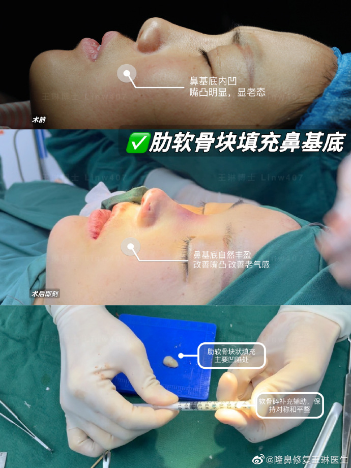 王琳隆鼻案例